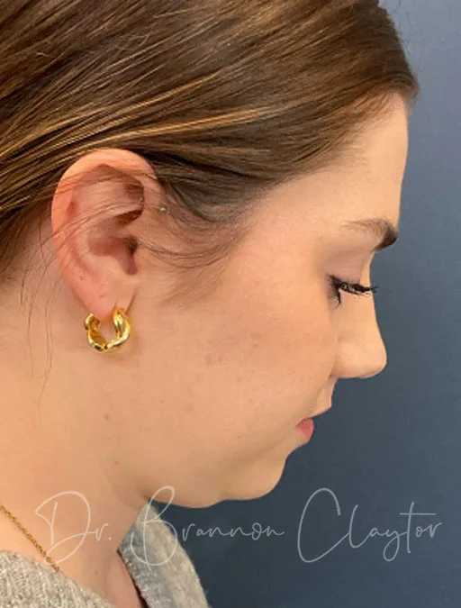MyEllevate Neck Lift