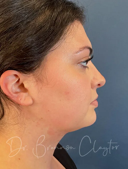 MyEllevate Neck Lift & SmartLipo