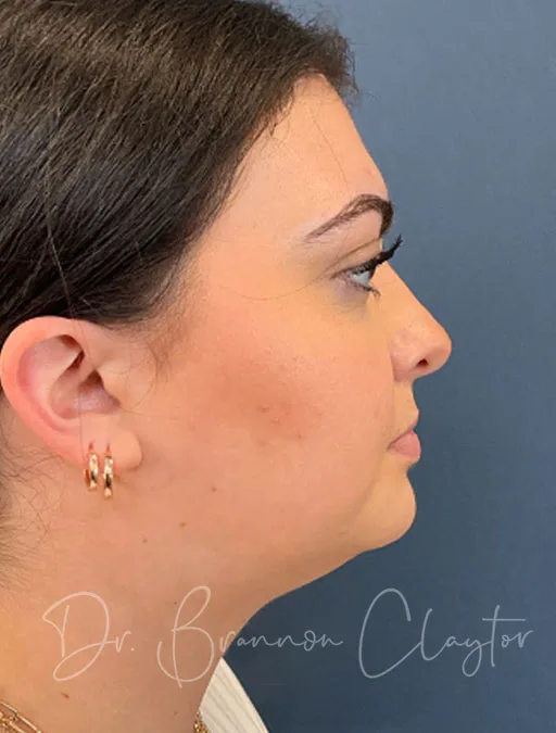 MyEllevate Neck Lift & SmartLipo
