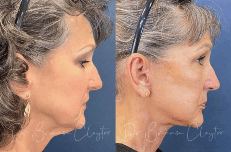 Result of female facelift Philadelphia
