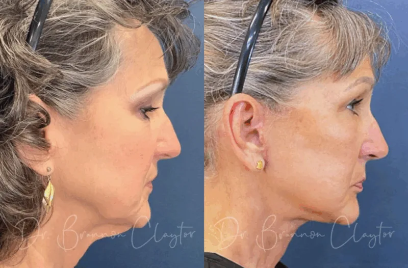 Result of female facelift Philadelphia