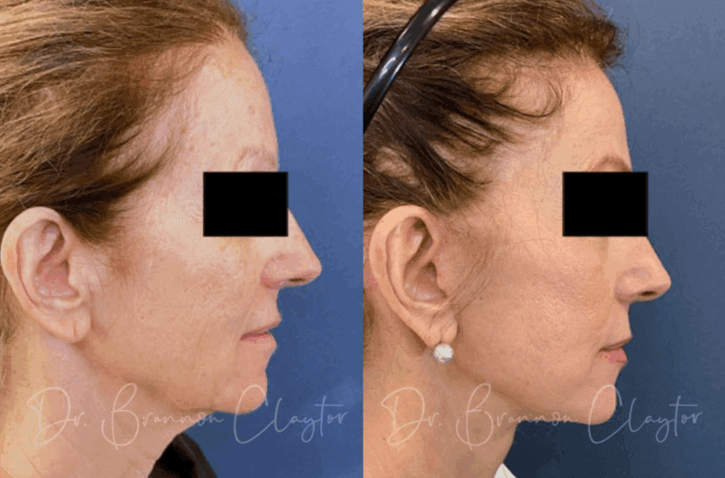 Philadelphia facial lift with neck lift