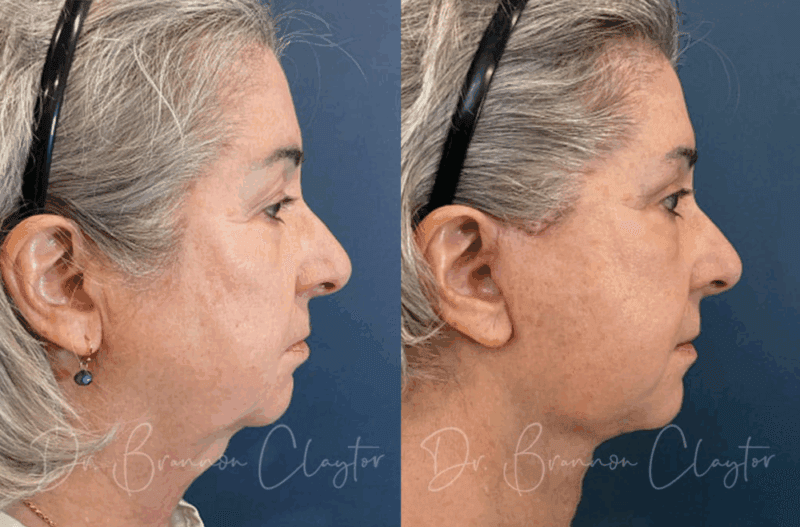 Before and after facelift Philadelphia with neck and eyelid lift for full facial rejuvenation