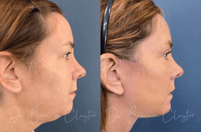 Philadelphia deep plane facelift with neck and upper eyelid surgery for full facial rejuvenation