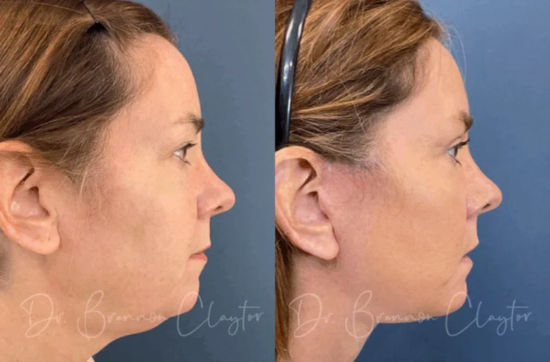 Philadelphia deep plane facelift with neck and upper eyelid surgery for full facial rejuvenation