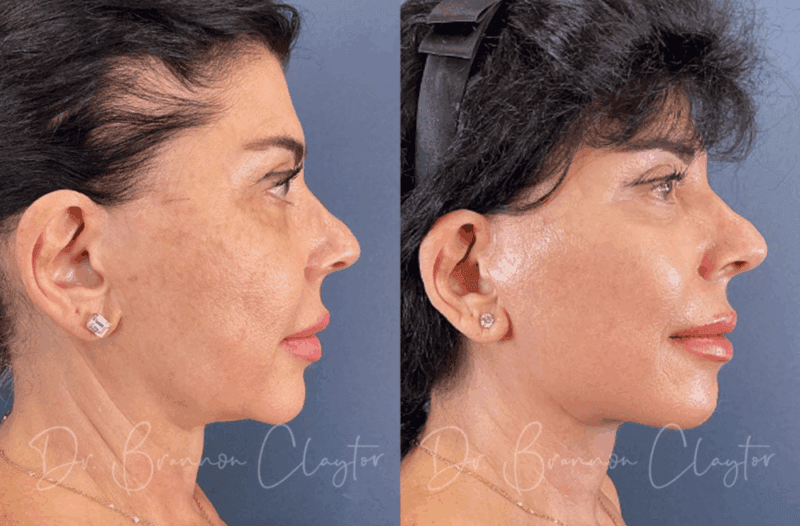 Before and after facelift surgery with Philadelphia facelift specialist Dr. Brannon Claytor
