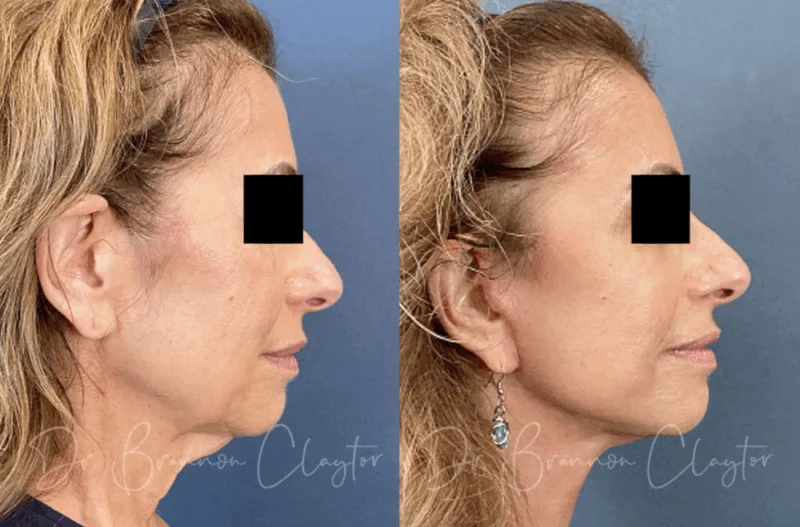 Before and after facelift with top facelift doctor Philadelphia Dr. Claytor