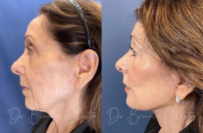 Before and after anti-aging facelift Philadelphia