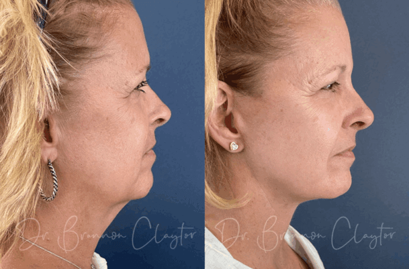 Before and after cosmetic facelift Philadelphia