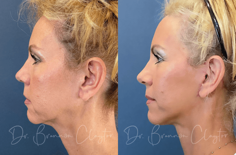 Before and after facelift in Philadelphia