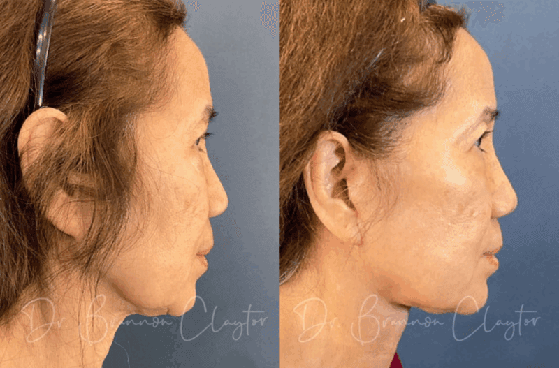 Before and after deep plane facelift and neck lift with Philadelphia facelift specialist Dr. Claytor