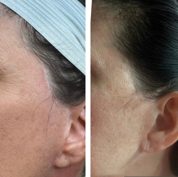 Before and after tattoo concealment for facelift scars
