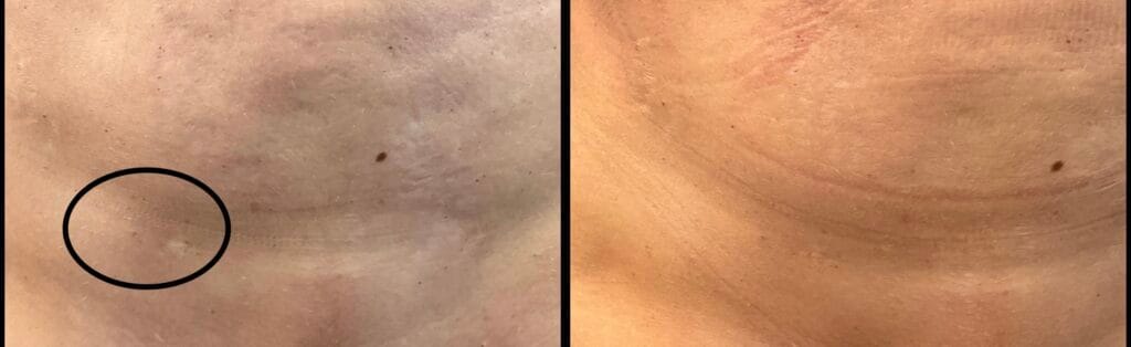 Before and after tattoo concealment for liposuction scar