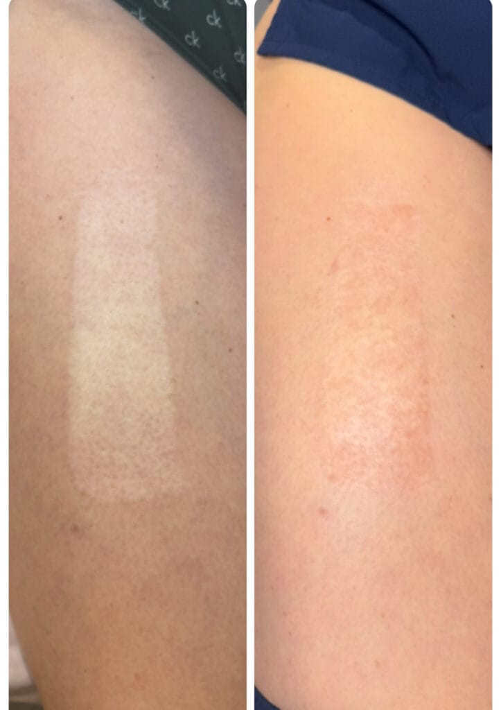 Before and after skin graft scar tattooing