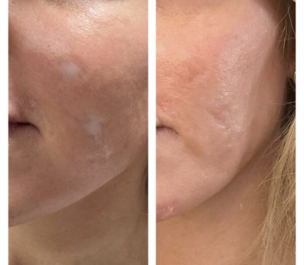 Before and after tattoo concealment for steroid injection scar
