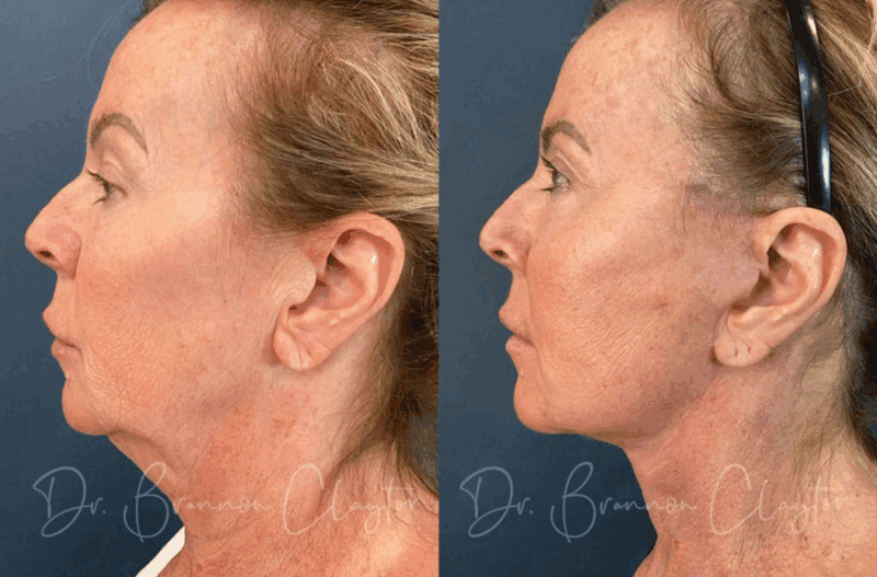 Before and after a natural-looking facelift Philadelphia with Dr. Claytor