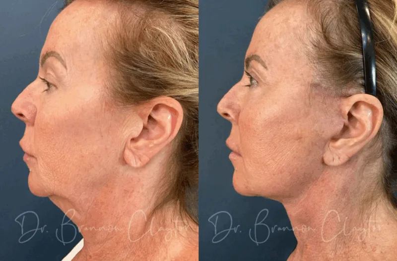 Before and after a natural-looking facelift Philadelphia with Dr. Claytor