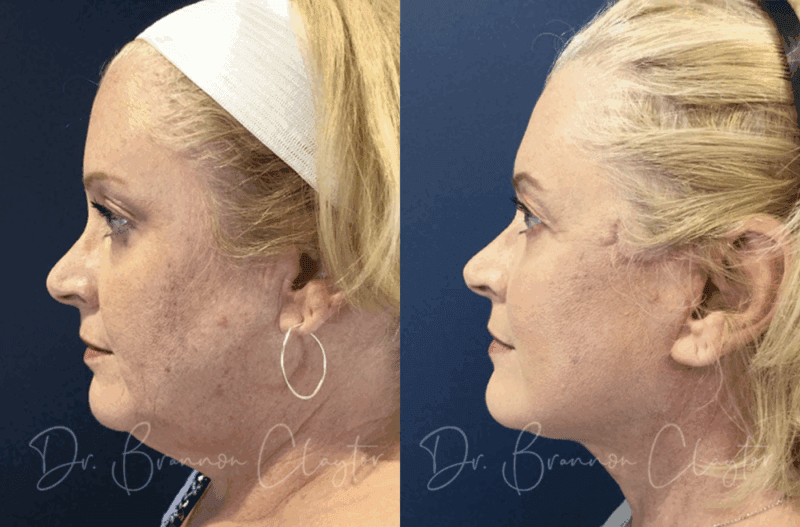 Before and after Philadelphia facial plastic surgery with facelift and neck liposuction