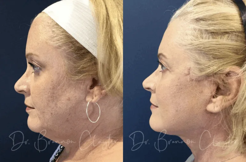 Before and after Philadelphia facial plastic surgery with facelift and neck liposuction