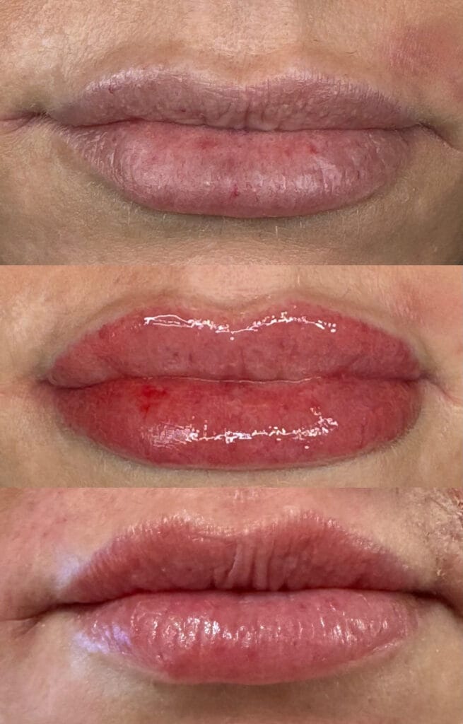 Before, immediately after, and healed lips after lip blushing