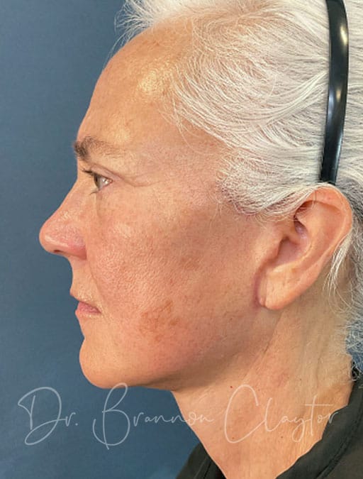 Deep Plane Facelift & Neck Lift