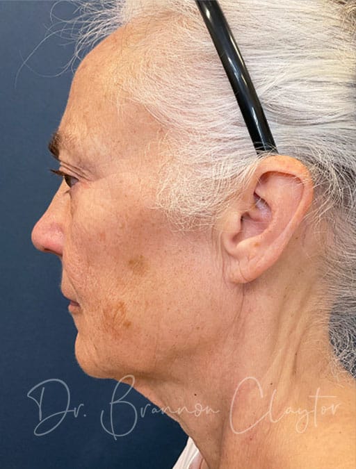 Deep Plane Facelift & Neck Lift
