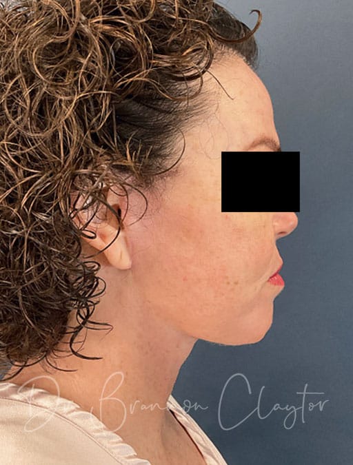 Deep Plane Facelift & Neck Lift
