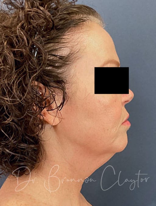 Deep Plane Facelift & Neck Lift