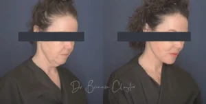 50yoDPfaceliftcensored