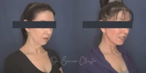 54yoDPFaceliftcensored