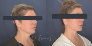 56yoDPFaceliftcensored