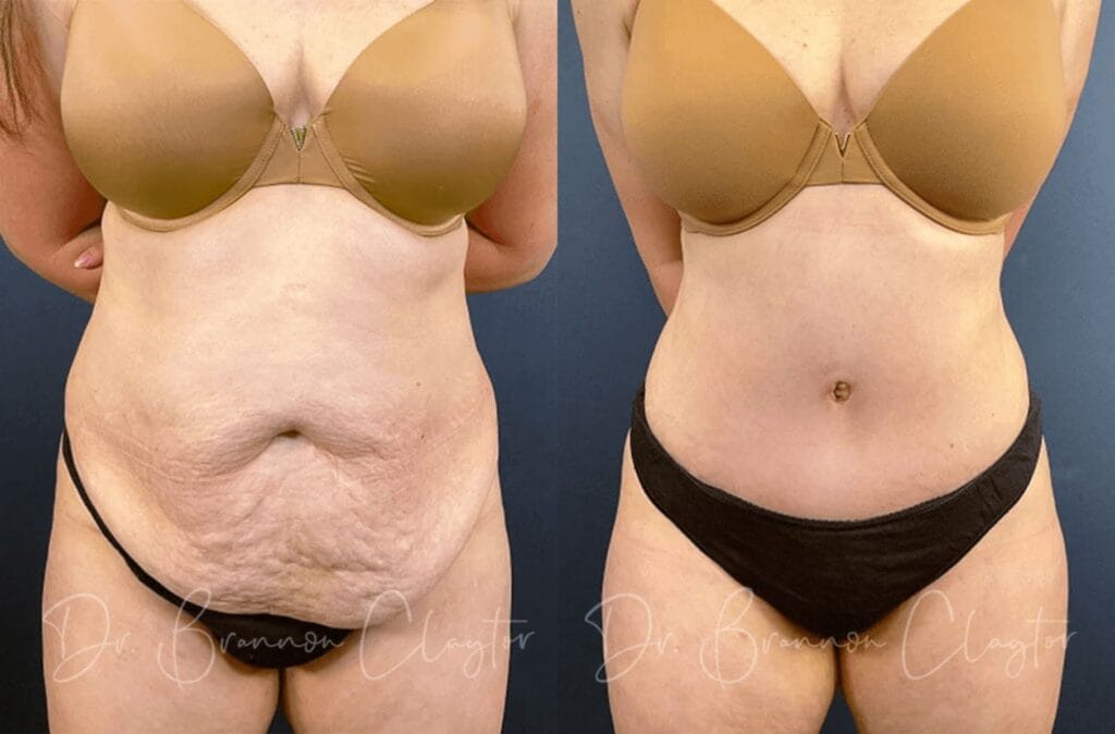 Drainless Tummy Tuck Before and After Patient