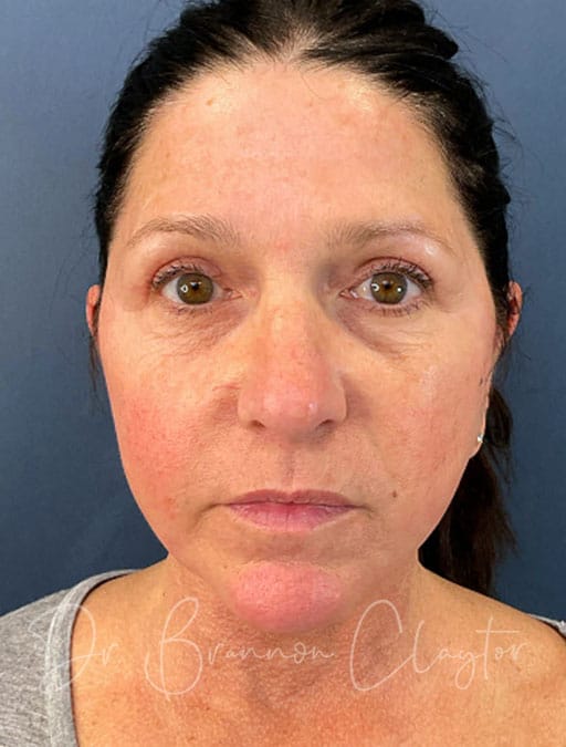 deep-plane-facelift-necklift-47513a-after-cnplastics