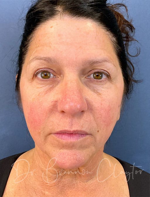 deep-plane-facelift-necklift-47513a-before-cnplastics