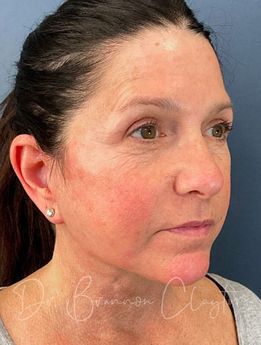 deep-plane-facelift-necklift-47513b-after-cnplastics