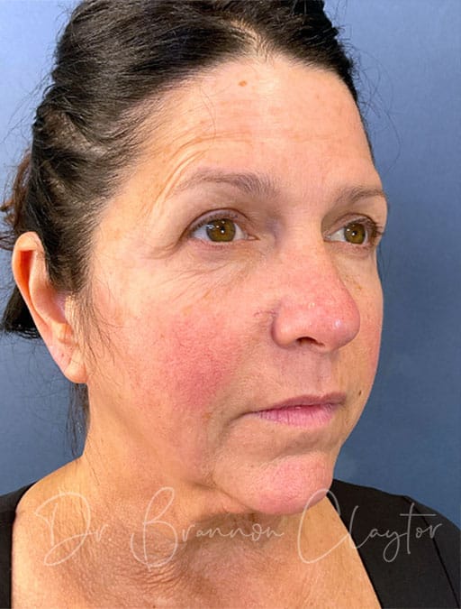 deep-plane-facelift-necklift-47513b-before-cnplastics