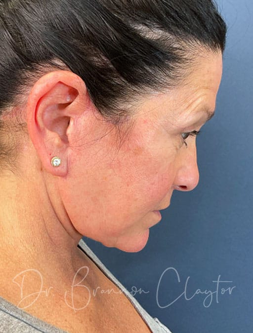 deep-plane-facelift-necklift-47513c-after-cnplastics