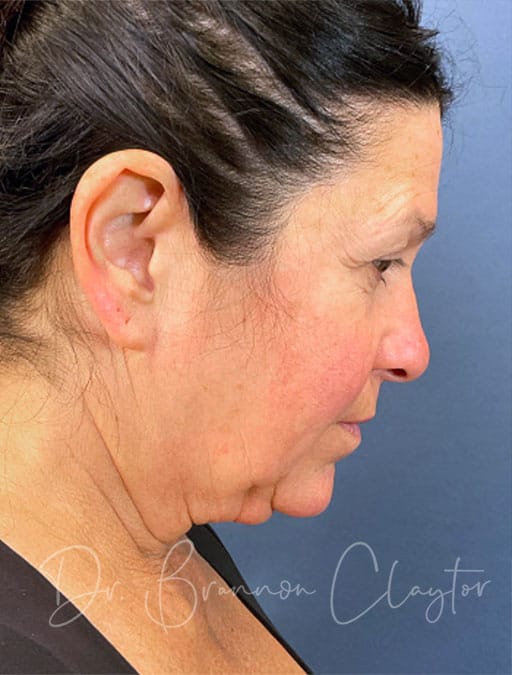 deep-plane-facelift-necklift-47513c-before-cnplastics