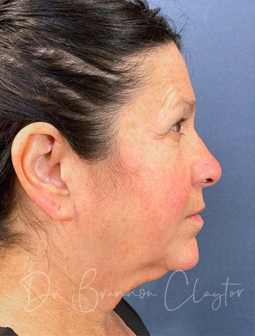 Deep Plane Facelift & Neck Lift