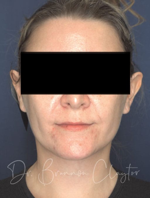 neck-lift-MIMS-54133a-after-cnplastics