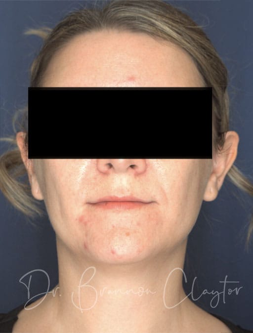 neck-lift-MIMS-54133a-before-cnplastics