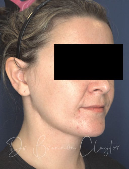 neck-lift-MIMS-54133b-after-cnplastics