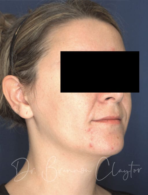 neck-lift-MIMS-54133b-before-cnplastics