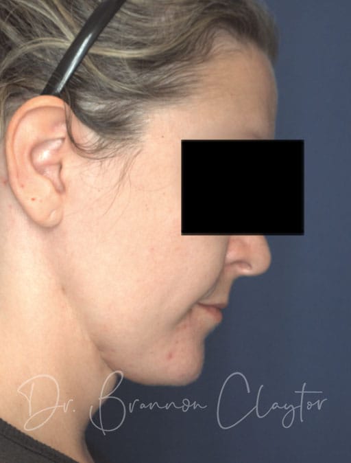 neck-lift-MIMS-54133c2-after-cnplastics