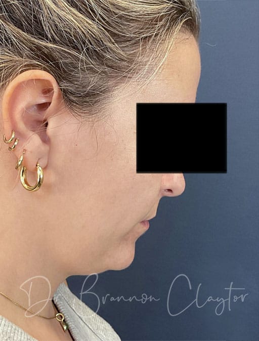 neck-lift-MIMS-54133c2-before-cnplastics