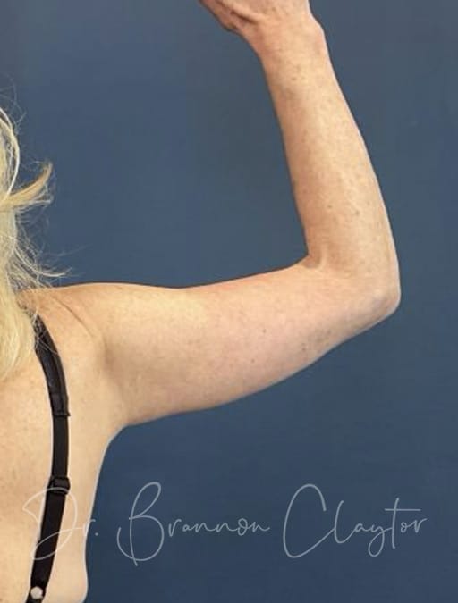 arm-lift-49534d-right-after-claytor