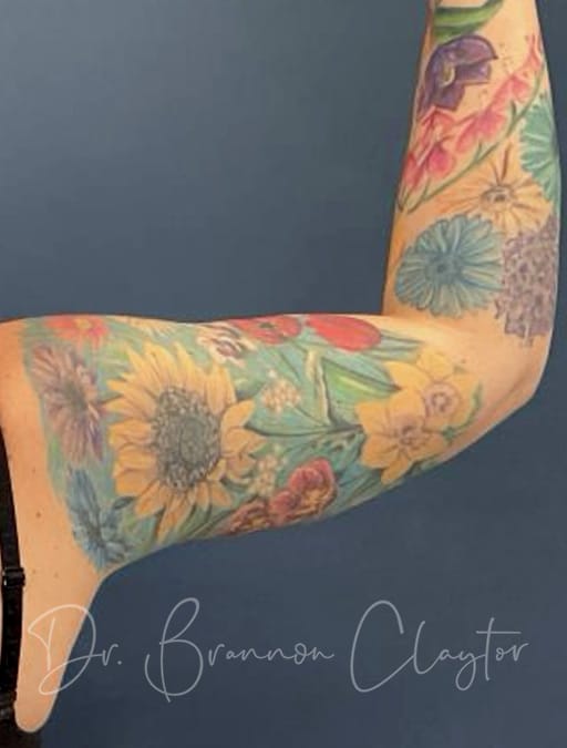 arm-lift-50669d-right-after-cnclaytor