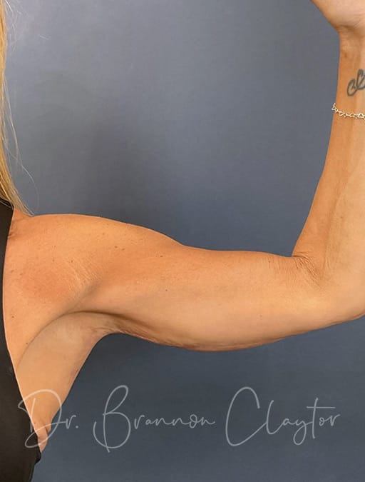 arm-lift-51354a-left-after-cnplastics