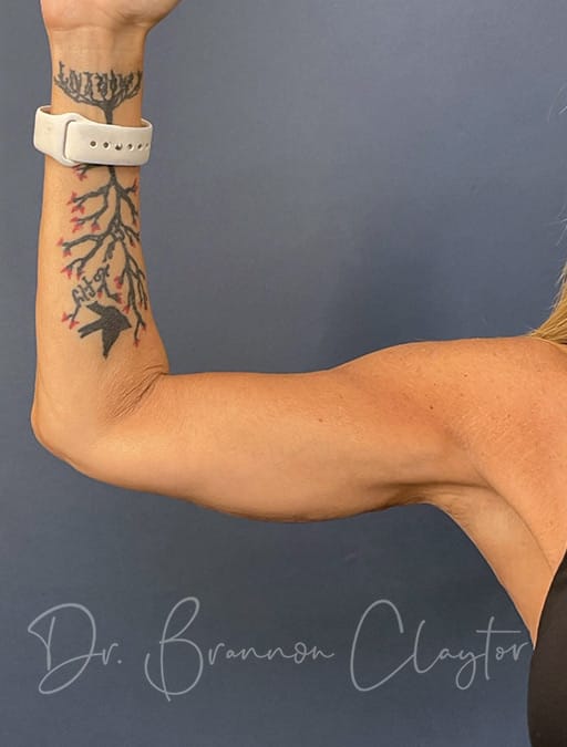 arm-lift-51354a-right-after-cnplastics