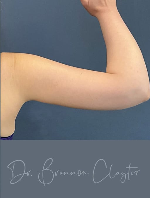 arm-lift-52835d-right-after-cnplastics